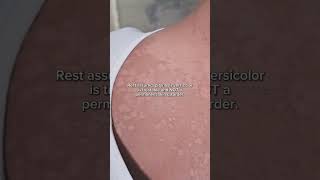 Pityriasis Versicolor What You Need to Know [upl. by Picardi]