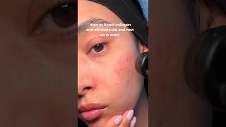 Microneedling results acnescars hyperpigmentation microneedling microneedlingbeforeandafter [upl. by Triny]