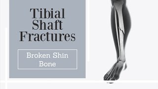 Tibial Shaft Fractures  Broken Shin Bone  leg fracture [upl. by Gnuhp]