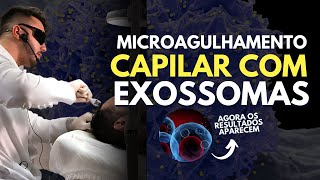 Microagulhamento CAPILAR com EXOSSOMAS  Aula prática [upl. by Eenyaj]