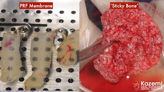 Platelet Rich Fibrin PRF Preparation for Membrane and Sticky Bone for Grafting [upl. by Juli914]