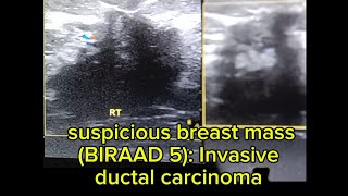 ultrasound of suspicious breast mass BIRAD 5 Invasive ductal carcinoma [upl. by Nostets]