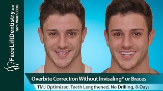 Overbite Correction No Braces or Invisalign® No Surgery in 8Days [upl. by Assille]