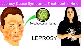 Leprosy Cause Symptoms Treatment Prevention in Hindi  Leprosy In Hindi  LeprosyHansens disease [upl. by Jeraldine431]