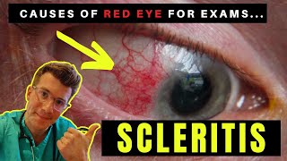 Causes of Red Eye  Part 3 SCLERITIS [upl. by Lucchesi]