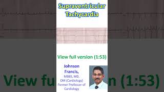 Supraventricular Tachycardia [upl. by Aneladdam]