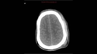 Diffuse axonal InjuryCases [upl. by Samoht]