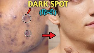 How to treat ACNE SCARS amp ACNE MARKS Dermatologist Answers Filipino  Jan Angelo [upl. by Howland]