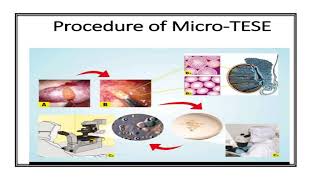 Sperm Retrieval Techniques Video No 412 [upl. by Ellekram988]