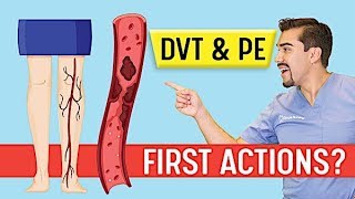 DVT Animation Deep Vein Thrombosis and Pulmonary Embolism PE Memory Tricks for Exams NCLEX [upl. by Johiah]