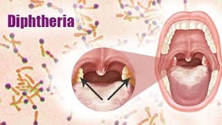 Diphtheria  Introduction of diphtheria  Definition of diphtheria  causes of diphtheria💯✨ [upl. by Sheldon]