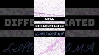 WellDifferentiated Liposarcoma  Atypical Lipomatous Tumor WDLALT  3 Things To Know  BSTPATH [upl. by Ayiram745]