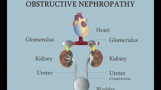 Obstrucción de la unión ureterovesical [upl. by Konrad]