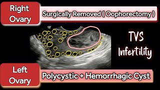 Left Polycystic Ovary PCOD  Hemorrhagic Cyst  Right Ovary Oophorectomy  TVS Infertility [upl. by Ramaj428]