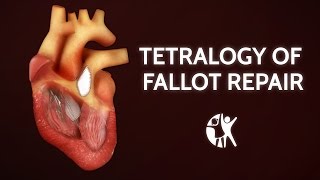 Tetralogy of Fallot Repair  Cincinnati Childrens [upl. by Woodson638]