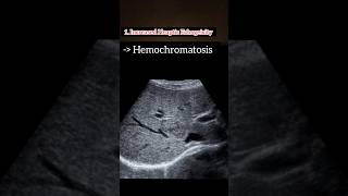 Hemochromatosis leading to Coarse Liver ❤️💯 HealthAwareness LiverHealth medical ultrasound [upl. by Irmine118]