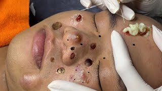 blackheads new 2023  popping pimple today  blackheads and whiteheads removal [upl. by Ahseniuq126]