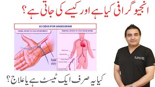 What is Angiography  Ye sirf ek Test hai Yaa Treatment  Dr Saeed Afridi [upl. by Waal171]