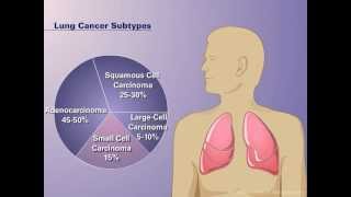 The Pathophysiology of Nonsmall Cell Lung Cancer [upl. by Magen]