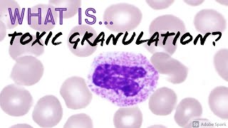 What is quotToxic Granulationquot of Neutrophils Why does it happen Hemepath Hematology Basics [upl. by Adrea]