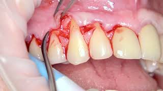 Coronally advanced flap CAF in upper canine area [upl. by Rod]