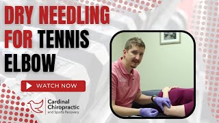 Dry Needling For Tennis Elbow  Your Burlington NC Chiropractor [upl. by Flossi777]