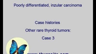 Poorly differentiated inzular carcinoma Other rare tumors  case 3 [upl. by Sturdivant]