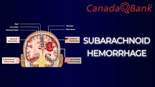 Subarachnoid Hemorrhage [upl. by Gnuhc670]