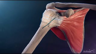 FxBridge™ Tuberosity Repair System Reverse Total Shoulder Arthroplasty [upl. by Pytlik]