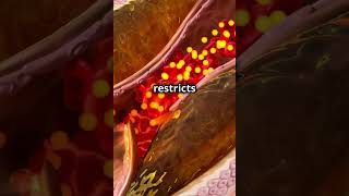 “Atherosclerosis Explained in 50 Seconds”hearthealth wellnesstips medfacts ournursesourfuture [upl. by Delaryd320]