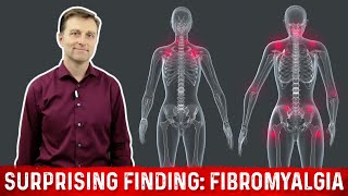 What is Fibromyalgia – Surprising Finding Explained by Dr Berg [upl. by Raeann]