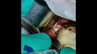 Lingually Inclined Distoangular Third Molar Removal [upl. by Sulienroc]