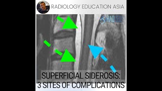 SUPERFICIAL SIDEROSIS 3 COMPLICATIONS TO LOOK FOR IN NERVE ROOTS CORD amp THECAL SAC [upl. by Marin]