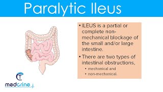 Paralytic Ileus  causes pathophysiology clinical features diagnosis and treatment [upl. by Asiled573]