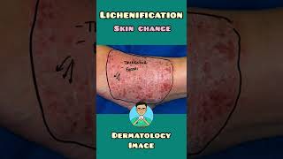 Lichenification  Dermatology  shorts [upl. by Eetsim]