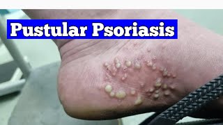 Transform Your Life Effective Strategies for Pustular Psoriasis [upl. by Ykciv211]