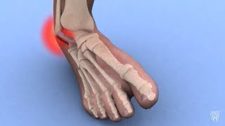 Mayo Clinic Minute Ankle sprains 101 [upl. by Gannes754]