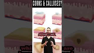 Foot CORNS amp CALLUSES How To Get Rid Of Them For Good [upl. by Ainalem]