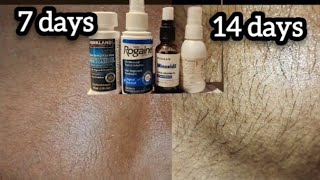 MINOXIDIL RESULTS MENUMBUHKAN BREWOKRAMBUT [upl. by Johnna]