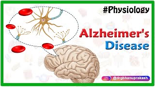 Alzheimers disease  Etiology Pathophysiology Signs and symptoms Diagnosis and Treatment [upl. by Sladen]