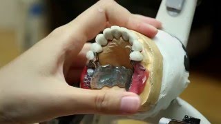 Prothèse clipsée sur dents Réalisation  Endurance Implant [upl. by Mosira]