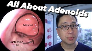 What are Adenoids [upl. by Lamahj]