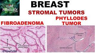 Diseases of Breast Part 3 Fibroadenoma amp Phyllodes tumor [upl. by Cardwell]