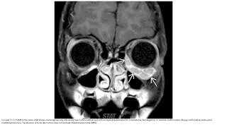 Rhabdomyosarcoma Head and Neck Imaging [upl. by Goraud475]