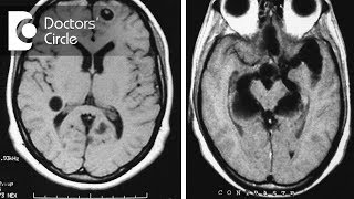 What do granuloma with Neurocysticercosis amp Tuberculoma in MRI brain signify  Dr Vykunta Raju K N [upl. by Aernda407]