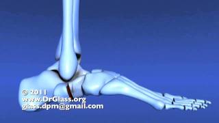 Evans Calcaneal Osteotomy of the Flat Foot [upl. by Strong]