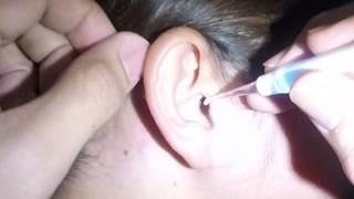 Girl with Disgusting Earwax Finally Removed [upl. by Raknahs793]