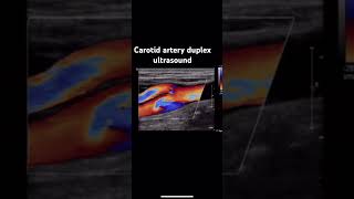 Carotid artery duplex ultrasound image video [upl. by Adigirb172]