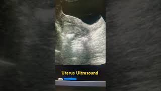 Pelvic ultrasound ultrasound pelvic uterus shortfeed shortsviral ytviral study medical yt [upl. by Hras]