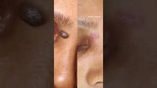 Facial Mole Removal Permanently  Surgical Method  Naevus Mole Removing with Techniques [upl. by Spooner]